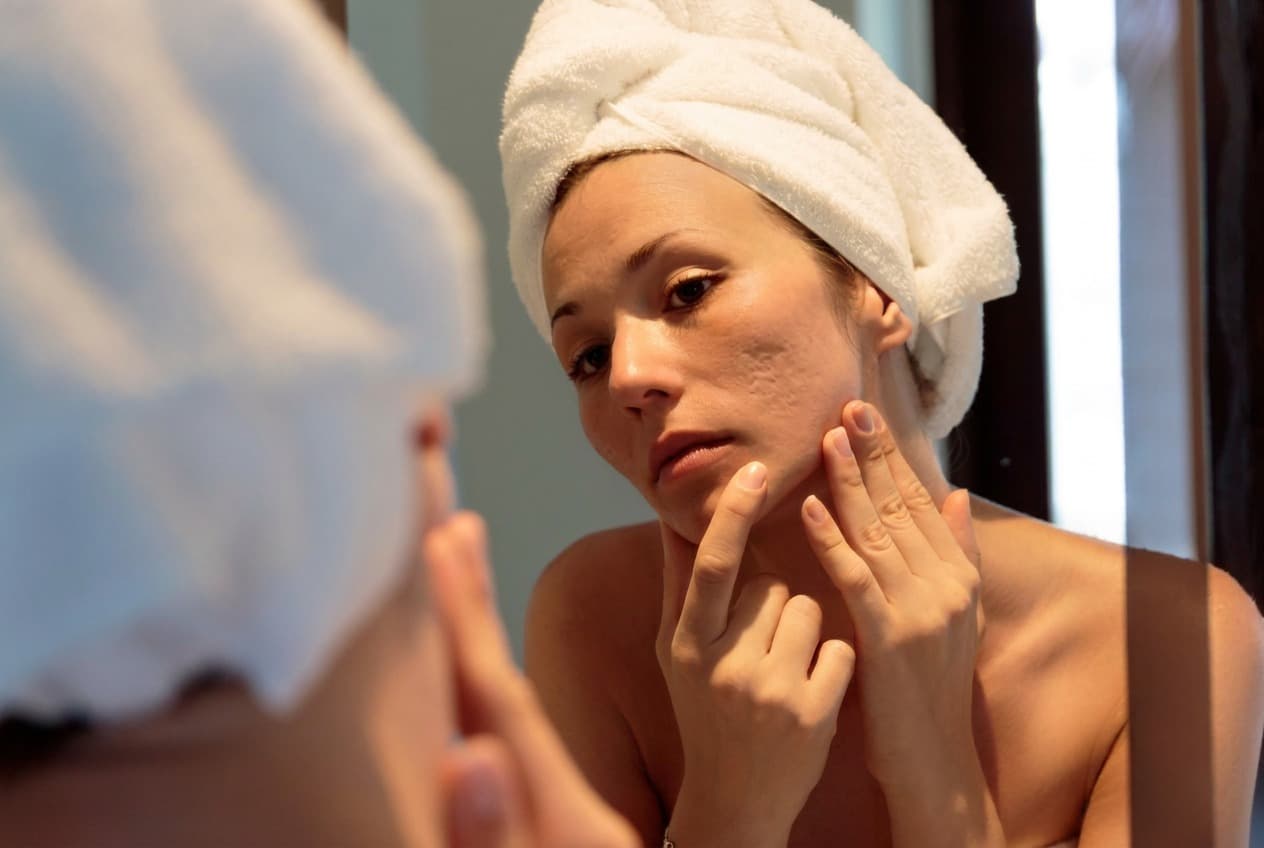 What Causes Scars and How Can I Minimize Them?