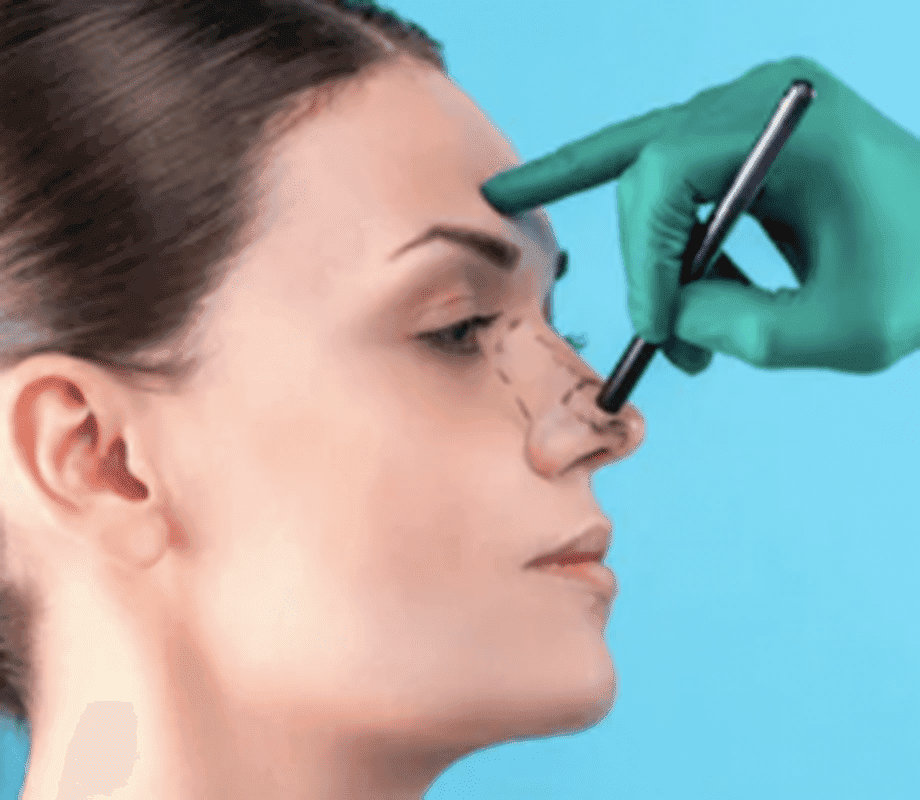 Rhinoplasty — treatment at Dr. Shawl's office